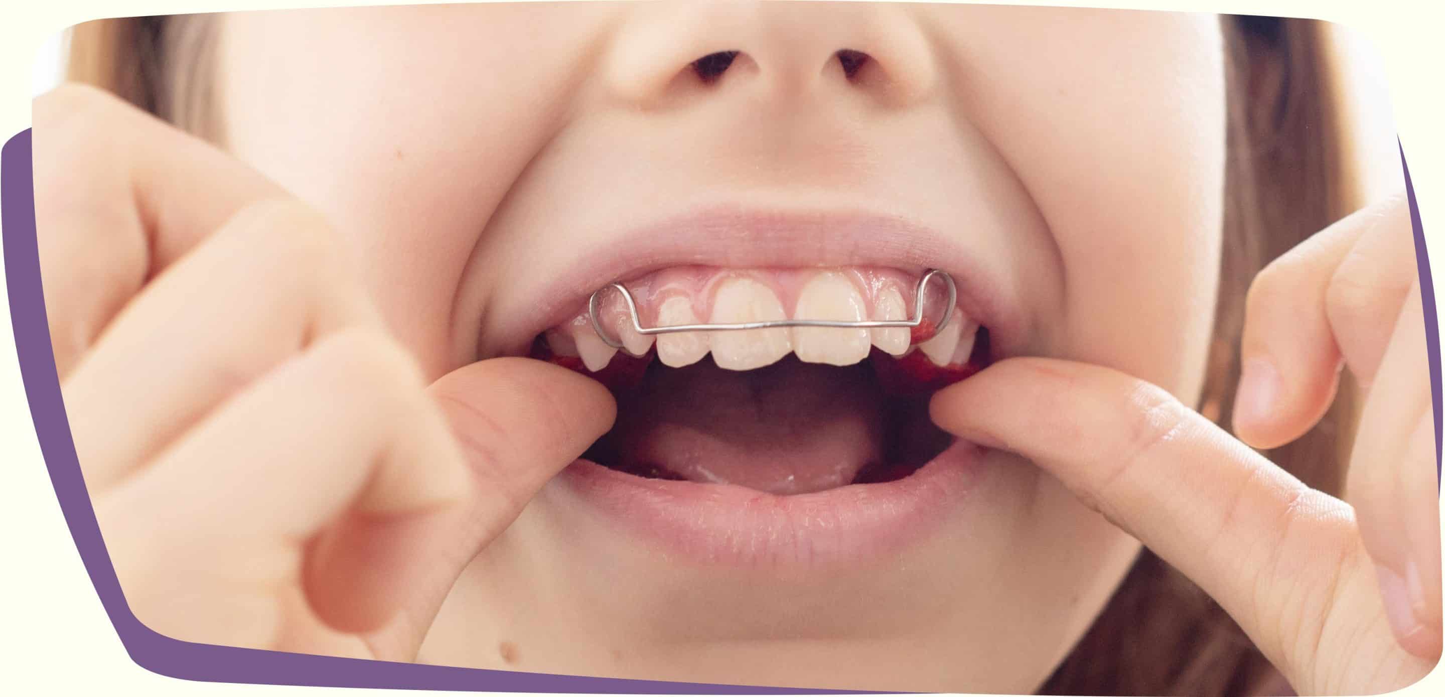 LitSmilesHabitAppliances-min Dental appliances for kids in Baton Rouge, LA